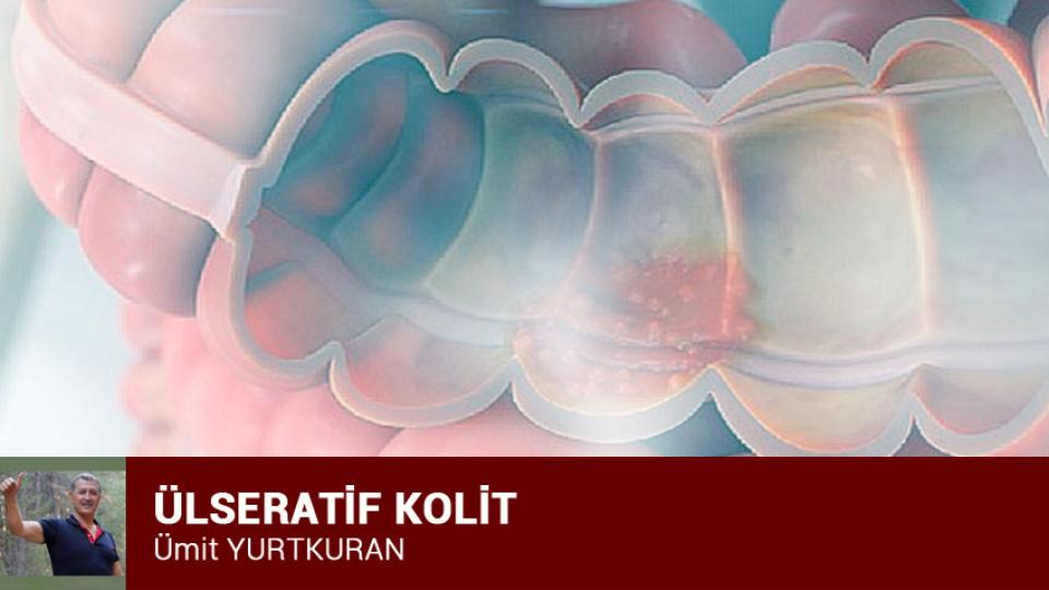 Baş Ağrısı, Yorgunluk veya Karnında  Sancısı Olanların Dikkatine! / Ümit YURTKURAN / ÜLSERATİF KOLİT / Ümit YURTKURAN